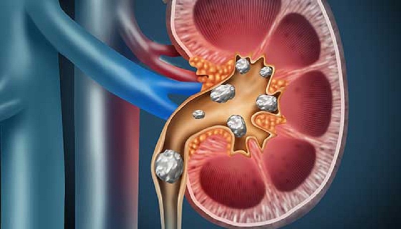 Kidney stone yt5jcl9wgu